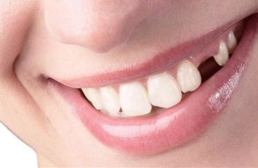 آنچه از جایگزینی دندان باید بدانیم